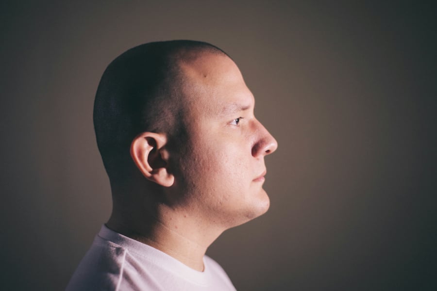 AI Tools Now Spot Signs of Balding